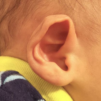 Ear Molding: Case 10 - Before