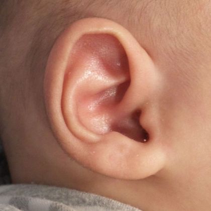 Ear Molding: Case 10 - After