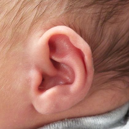 Ear Molding Case 11 - Before