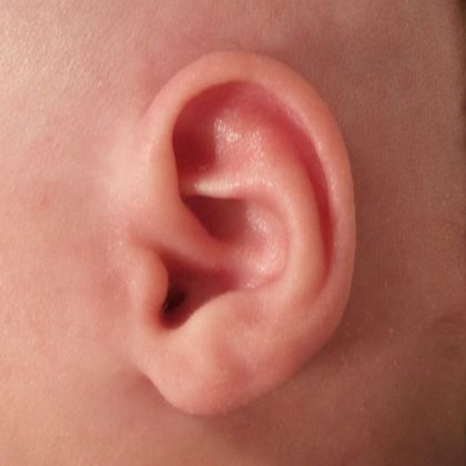 Ear Molding Case 11 - After