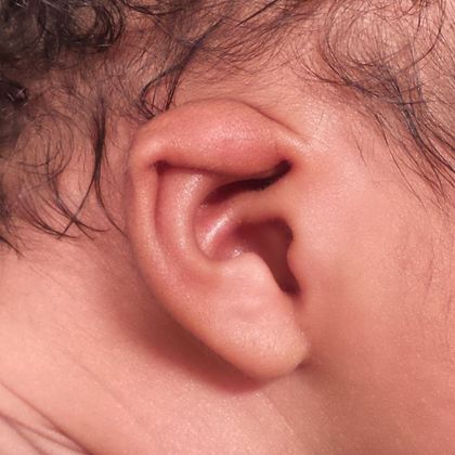 Ear Molding: Case 12 - Before