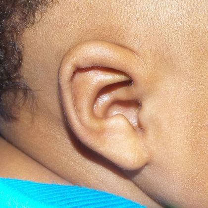 Ear Molding: Case 12 - After