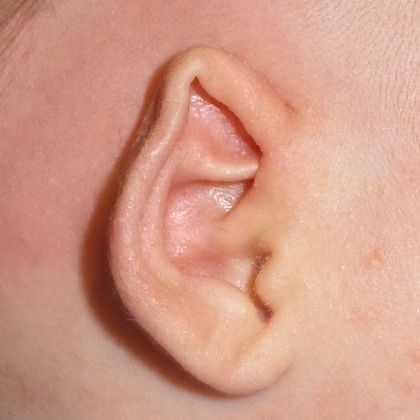 Ear Molding: Case 13 - Before