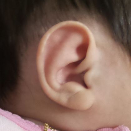 Ear Molding Case 14 - After