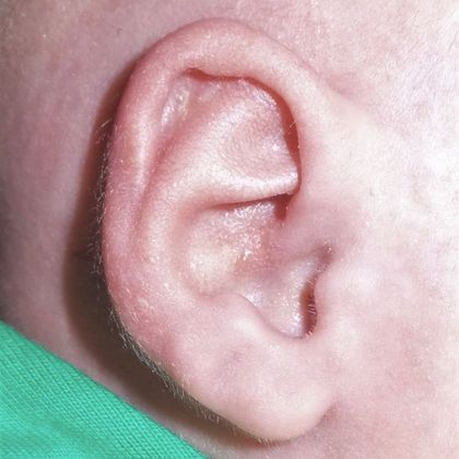 Ear Molding Case 15 - After