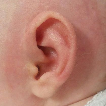 Ear Molding: Case 17 - After