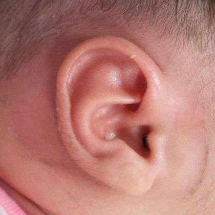 Ear Molding: Case 19 - After