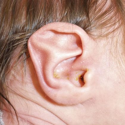 Ear Molding: Case 18 - Before