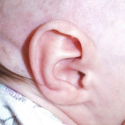 Ear Molding: Case 18 - After