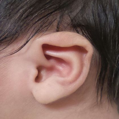 Ear Molding Case 20 - Before