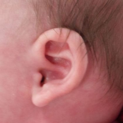 Ear Molding: Case 21 - Before