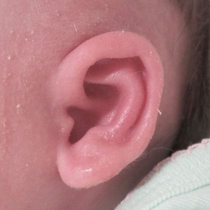 Ear Molding: Case 21 - After