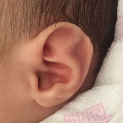 Ear Molding Case 22 - Before