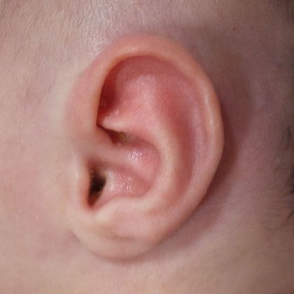 Ear Molding Case 22 - After