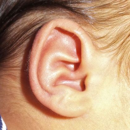 Ear Molding Case 23 - Before