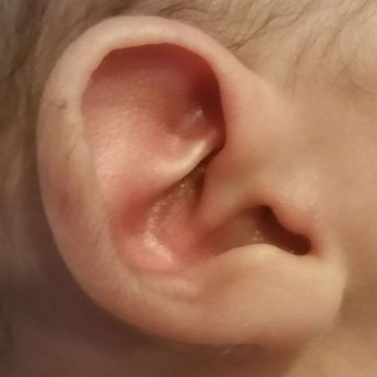 Ear Molding: Case 25 - Before