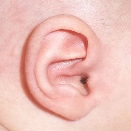 Ear Molding: Case 25 - After