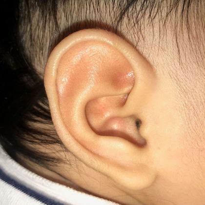 Ear Molding: Case 26 - After