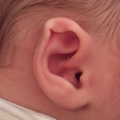 Ear Molding Case 27 - Before