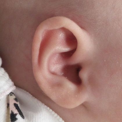 Ear Molding Case 27 - After