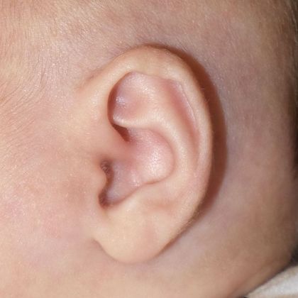 Ear Molding Case 28 - After