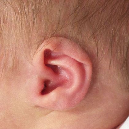 Ear Molding Case 29 - Before