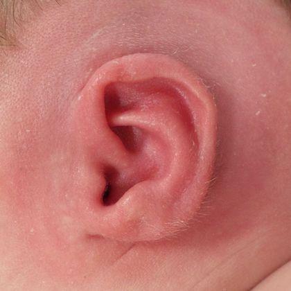 Ear Molding Case 29 - After