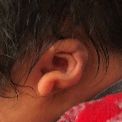 Ear Molding: Case 32 - Before