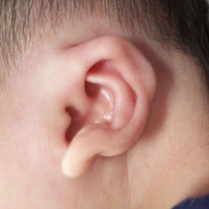 Ear Molding: Case 32 - After