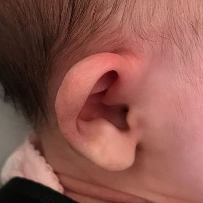 Ear Molding Case 34 - Before