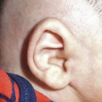 Ear Molding Case 35 - After