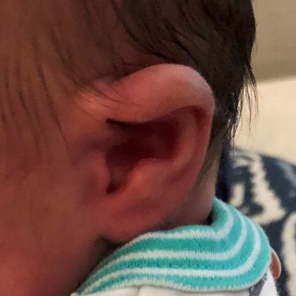 Ear Molding Case 37 - Before