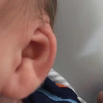 Ear Molding: Case 38 - Before