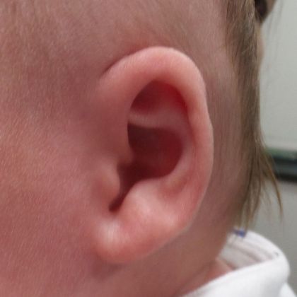 Ear Molding: Case 38 - After