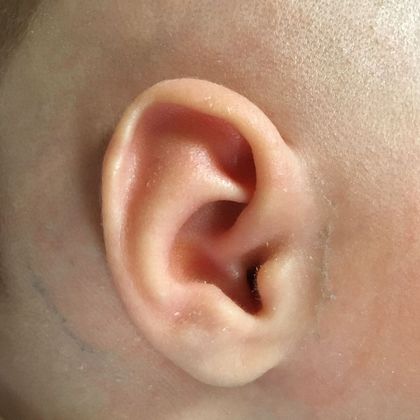 Ear Molding: Case 39 - Before