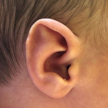 Ear Molding: Case 39 - Before
