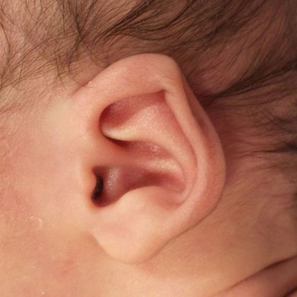 Ear Molding: Case 40 - Before