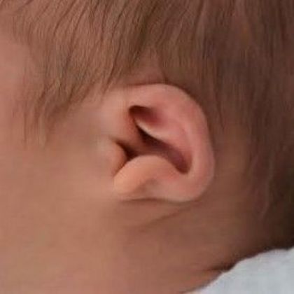 Ear Molding: Case 43 - Before