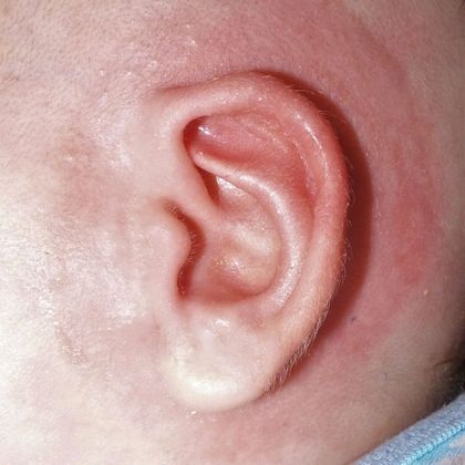 Ear Molding: Case 43 - After