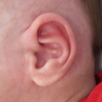 Ear Molding Case 46 - After