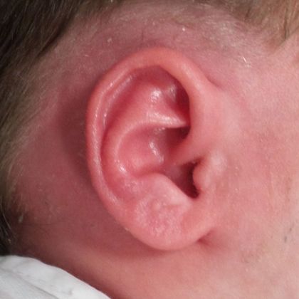 Ear Molding Case 48 - After