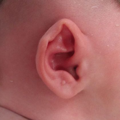 Ear Molding Case 48 - Before