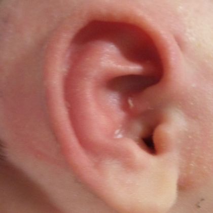Ear Molding Case 51 - After
