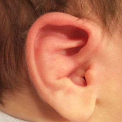 Ear Molding Case 51 - Before