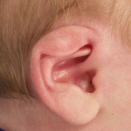 Ear Molding Case 52 - Before