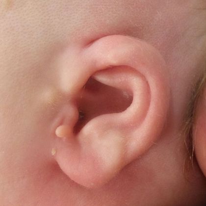 Ear Molding Case 53 - After