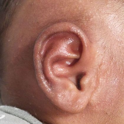 Ear Molding Case 56 - After