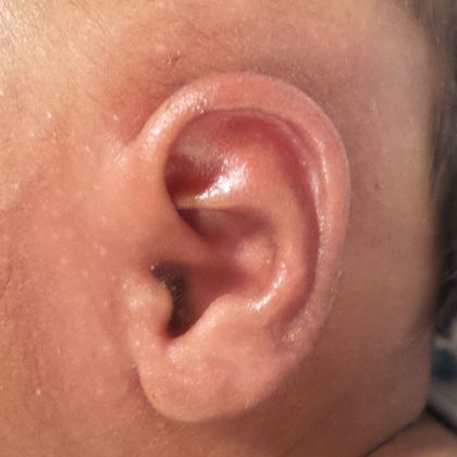 Ear Molding: Case 57 - After