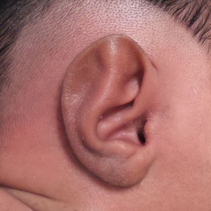 Ear Molding: Case 58 - Before