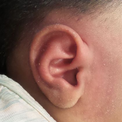 Ear Molding: Case 58 - After
